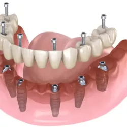 All-on-6 Dental Implants Hungary